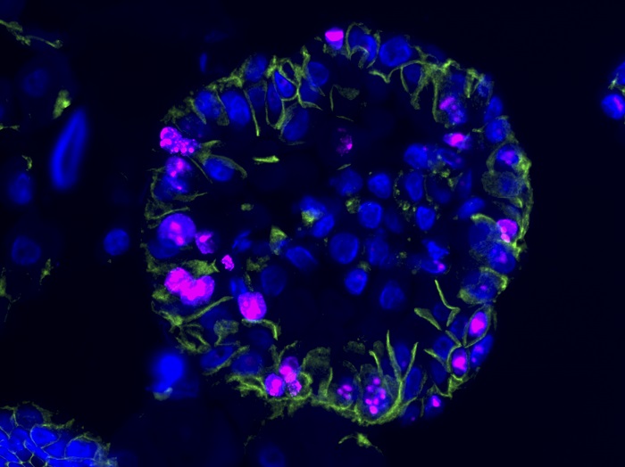Menschliche ccRCC-Organoide unter dem Mikroskop, markiert mit fluoreszenten Farbstoffen. Aus Krebsstammzellen wurden Miniaturversionen der Nierentumore gezüchtet. (Foto: AG Birchmeier, MDC)