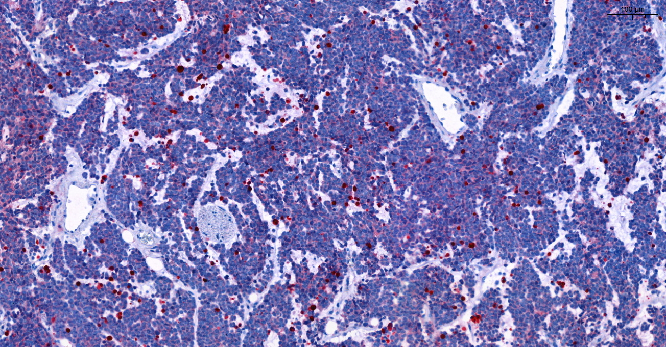 Rot eingefärbte, abgestorbene Zellen in DDX1-MYCN co-amplifizierten Neuroblastoma nach einer Rapamycin-Behandlung (Abb.: Henssen Lab, Max Delbrück Center)