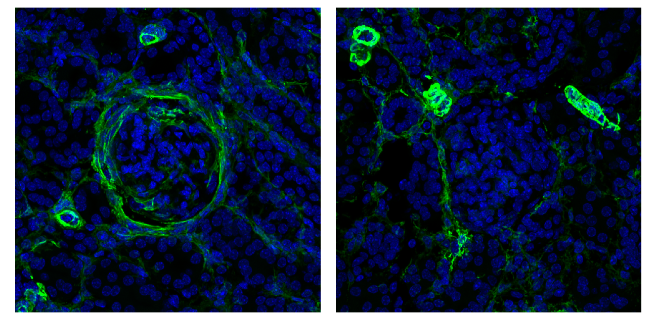 Kidney tissue (lupus mouse model) showing signs of incipient fibrosis (green). When the NKp46 receptor of the ILCs is blocked (right), the lupus nephritis recedes. Blue: cell nuclei. © Charité | Frauke Schreiber