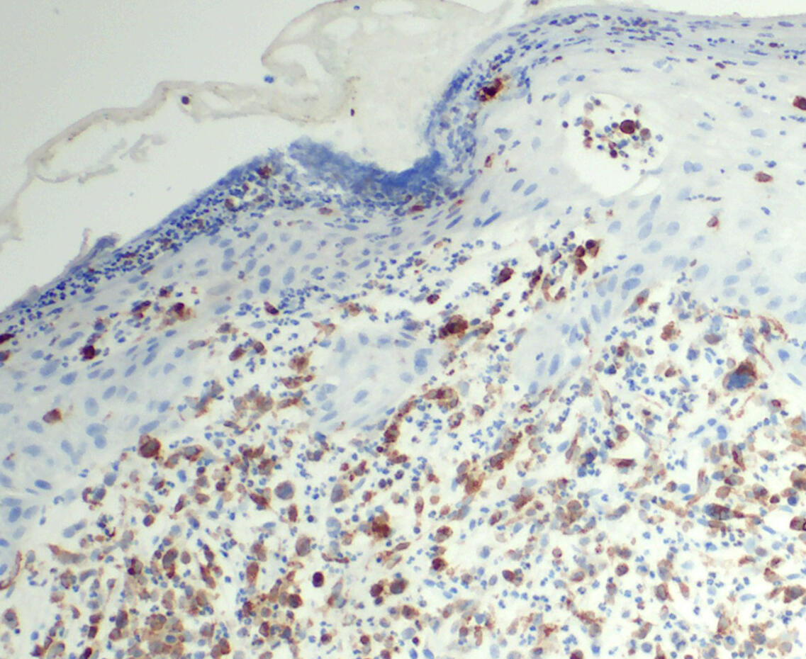 Cutaneous T-cell lymphoma with transformed cells (CD74 labeled in brown; skin cells are in blue).  © Charité | Ann-Christin von Brünneck