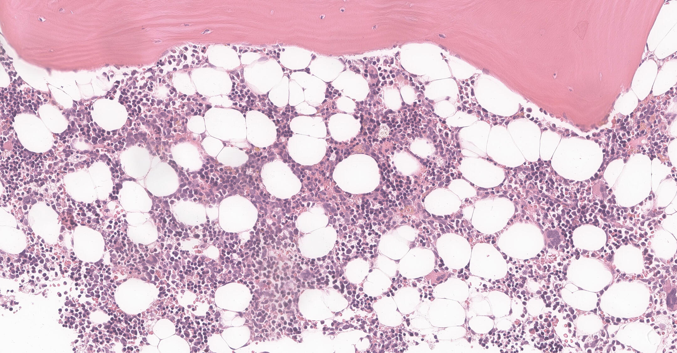 Mikroskopische Aufnahme einer Knochenmarkbiopsie mit Stamm- und Vorläuferzellen in violetter Farbe. (© Dr. Jana Ihlow, Charité – Universitätsmedizin Berlin)
